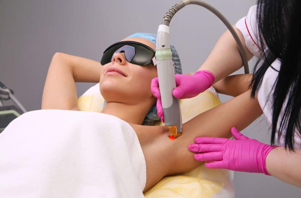 laser hair removal